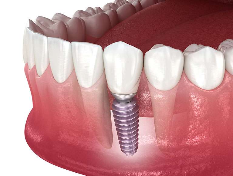 dental implants