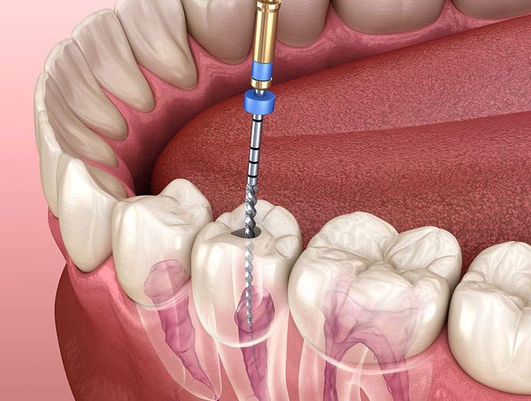 root canal theraphhy